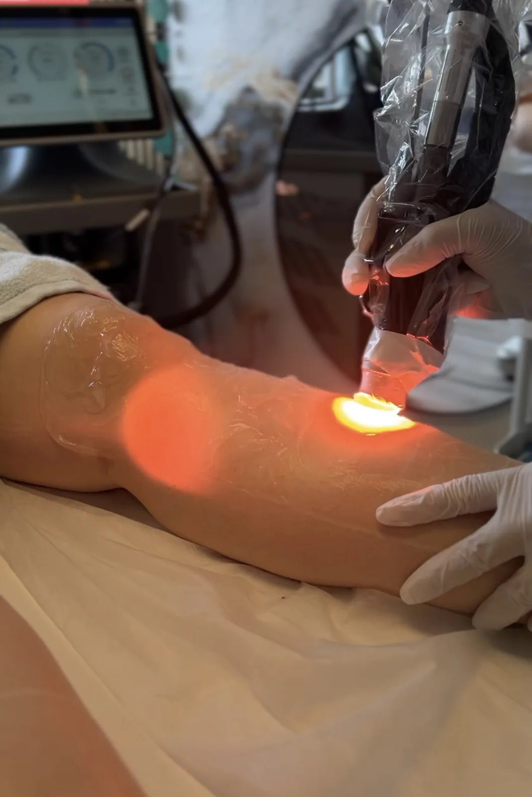 Laserbehandlung